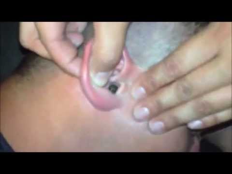 Un mec a un insecte coincé dans l'oreille