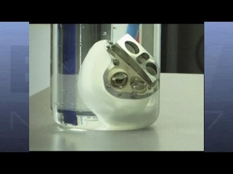 Une seconde greffe de cœur artificiel réalisée à Nantes