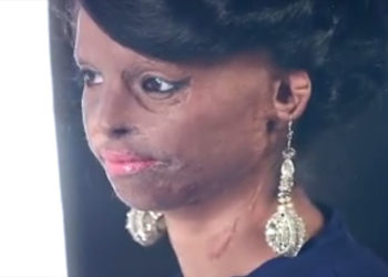 Inde : Une jeune femme brûlée à l’acide parvient à devenir mannequin !