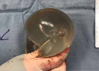 Canada : Sauvée par ses implants mammaires après avoir reçu une balle à bout portant