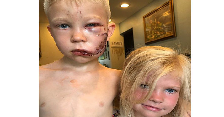 États-Unis : Il sauve sa petite sœur d&rsquo;une attaque de chien en se faisant mordre à sa place : 90 points de suture