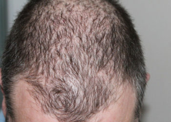 La greffe de cheveux, la solution la plus efficace contre la calvitie