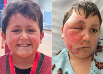 Un garçon de 9 ans gravement brûlé par un défi TikTok : l’hôpital lance un avertissement urgent