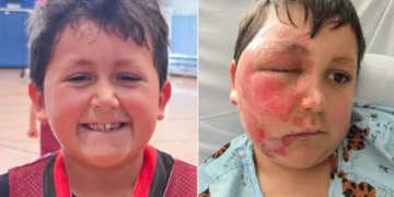 Un garçon de 9 ans gravement brûlé par un défi TikTok : l’hôpital lance un avertissement urgent