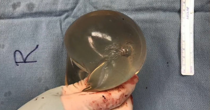 Canada : Sauvée par ses implants mammaires après avoir reçu une balle à bout portant