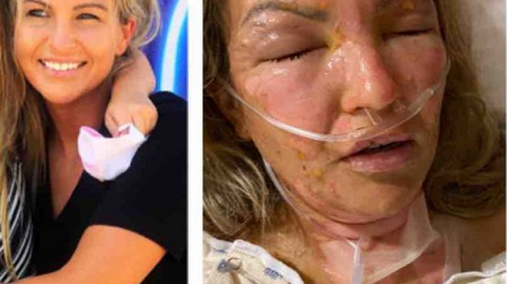 Texas. Une jeune femme grièvement brûlée au visage par son gel hydroalcoolique