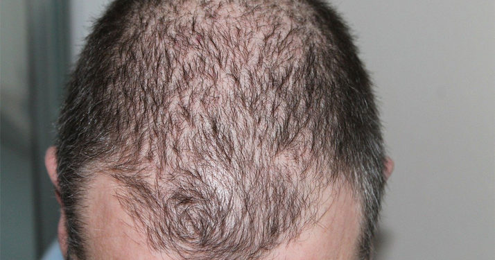 La greffe de cheveux, la solution la plus efficace contre la calvitie