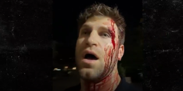 « J&rsquo;ai cru mourir » : Keegan Allen (Pretty Little Liars) violemment agressé et défiguré en pleine rue à Los Angeles